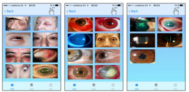 <p>Interfaz de la aplicación OphthalDSS, que entre otras opciones, ofrece imágenes de ojos con diversas enfermedades. / Manovel López et al.</p>