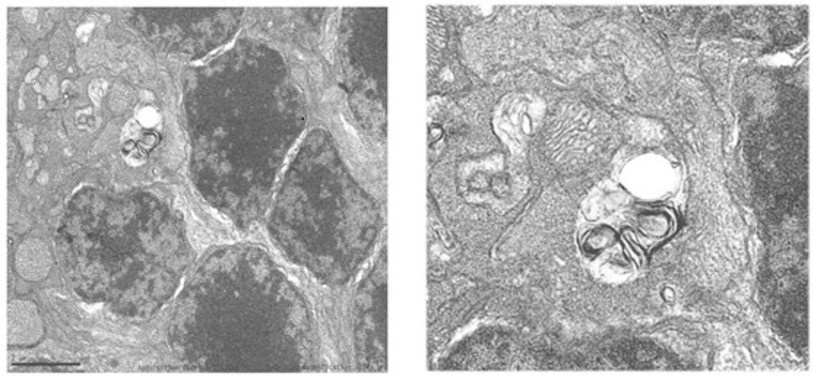 <p class=" text-left">Acumulación de autofagosomas en retinas de ratones deficientes en<strong> </strong><em>Igf1</em>. / UAM</p>