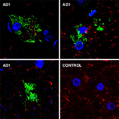 <p class=" text-left">Análisis de estructuras fúngicas en tejido de cerebro mediante inmunohistoquímica. El tejido cerebral de un individuo control (C1) es negativo, mientras que varias muestras de un paciente con enfermedad de Alzheimer (AD1) son positivas. Los núcleos celulares se han teñido con DAPI (azul), las estructuras fúngicas se evidencian mediante el uso de anticuerpos específicos (verde) y los neurofilamentos humanos se muestran en rojo. / UAM</p>
