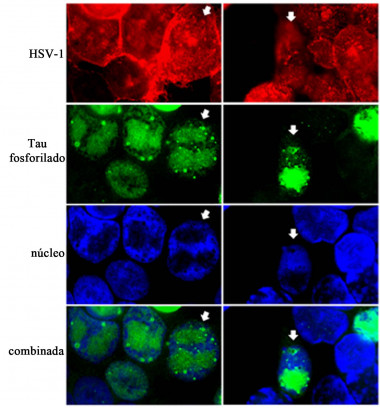 <p class=" text-left">La figura muestra que las células infectadas teñidas con un anticuerpo que reconoce la proteína viral gC (rojo) acumulan la proteína tau fosforilada (verde). La tinción nuclear con el agente DAPI (azul) revela que los acúmulos de tau están localizados en el núcleo (combinada). Imagen: UAM</p>