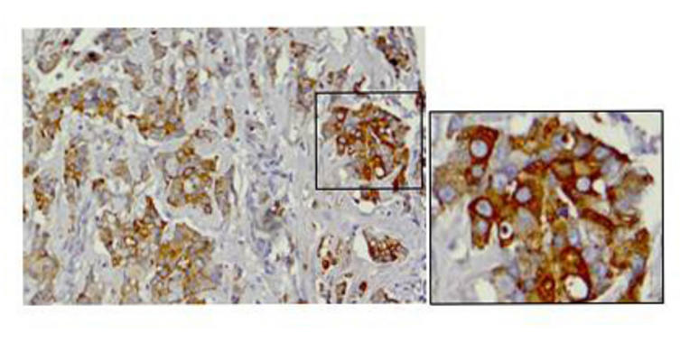 <p class=" text-left">Expresión de LOXL2 en carcinomas basales</p>