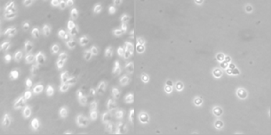 <p>Células de un paciente con linfoma del manto antes (imagen izquierda) y después (imagen derecha) del tratamiento con el fármaco. Se observa inhibición del crecimiento celular. / IDIBELL</p>