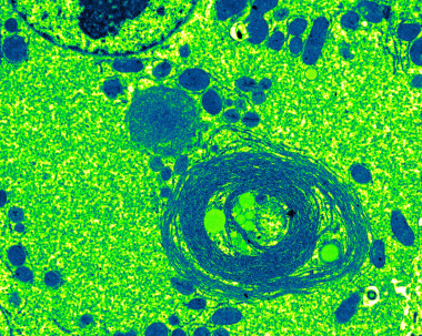 <p>Autofagia deficiente de células hepáticas, tomadas con microscopio electrónico, que muestran la eliminación defectuosa de los desechos celulares. / L. NOON (CIPF-CIBERDEM)</p>