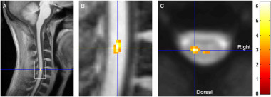<p>El trabajo analiza la respuesta al dolor mediante resonancias magnéticas de la medula espinal. Imagen: Sprenger et al. <em>Current Biology.</em></p>
