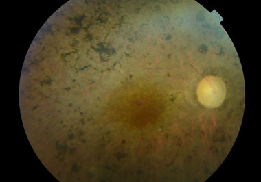 <p>Fondo de ojo de un paciente del presente estudio con retinosis pigmentaria. | Cistina Irigoyen/Hospital Donostia</p>