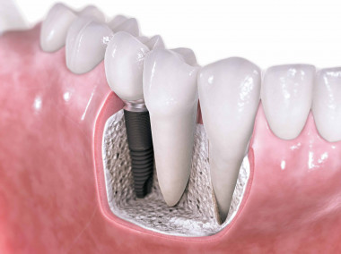 <p>Implante dental. / UJI</p>