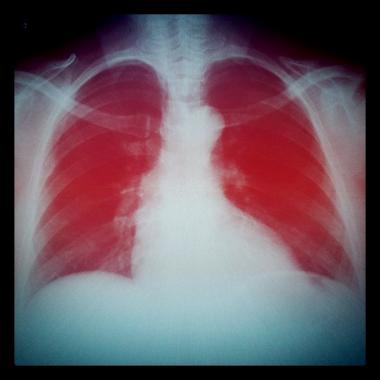 <p>La tasa de supervivencia de 6 meses fue de un 75% para los pacientes que recibieron pulmones tratados con la estrategia de protección. <a href="http://www.plataformasinc.es/esl/imagenes/inicio/(imagen)/69853" target="_blank">Foto</a>: Gustavo Amorín.</p>