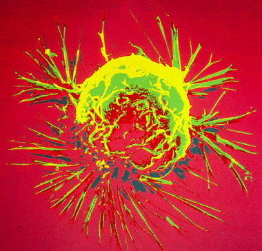 <p>Celula de cáncer de mama. / National Cancer Institute / Wikipedia (CC)</p>