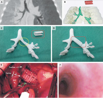<p>La férula fue creada con un biomaterial reabsorbible por el cuerpo en tres años. <em>/ </em>NEMJ</p>