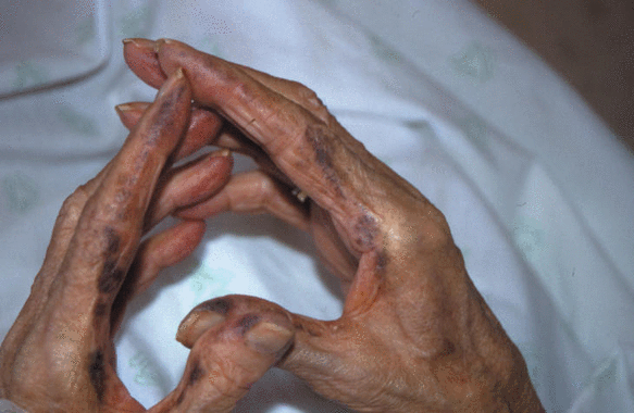 <p>Manos de una paciente diagnosticada de alcaptonuria. / <a href="http://zl.elsevier.es/es/revista/medicina-clinica-2/alcaptonuria-ocronosis-13045801-la-imagen-semana-2003" target="_blank">Elsevier</a></p>