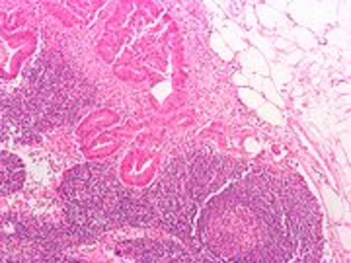 <p>En la imagen, metástasis de un adenocarcinoma colorrectal. Foto: Nephron.</p>