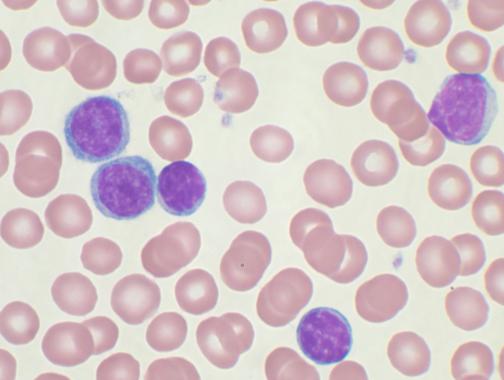 <p>Linfocitos de leucemia linfática crónica (en oscuro). Imagen: <a href="http://upload.wikimedia.org/wikipedia/commons/0/0d/Chronic_lymphocytic_leukemia.jpg" target="_blank">VashiDonsk</a></p>