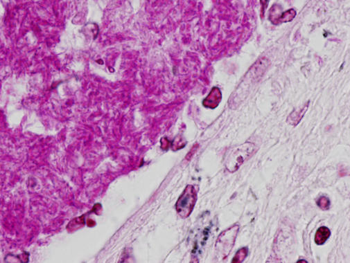 <p>Células infectadas de tuberculosis. Imagen: DICYT.</p>