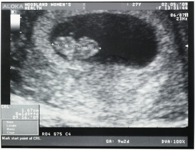 <p>Ultrasonido de un feto humano de 8 semanas de edad gestacional. / Ragesoss</p>