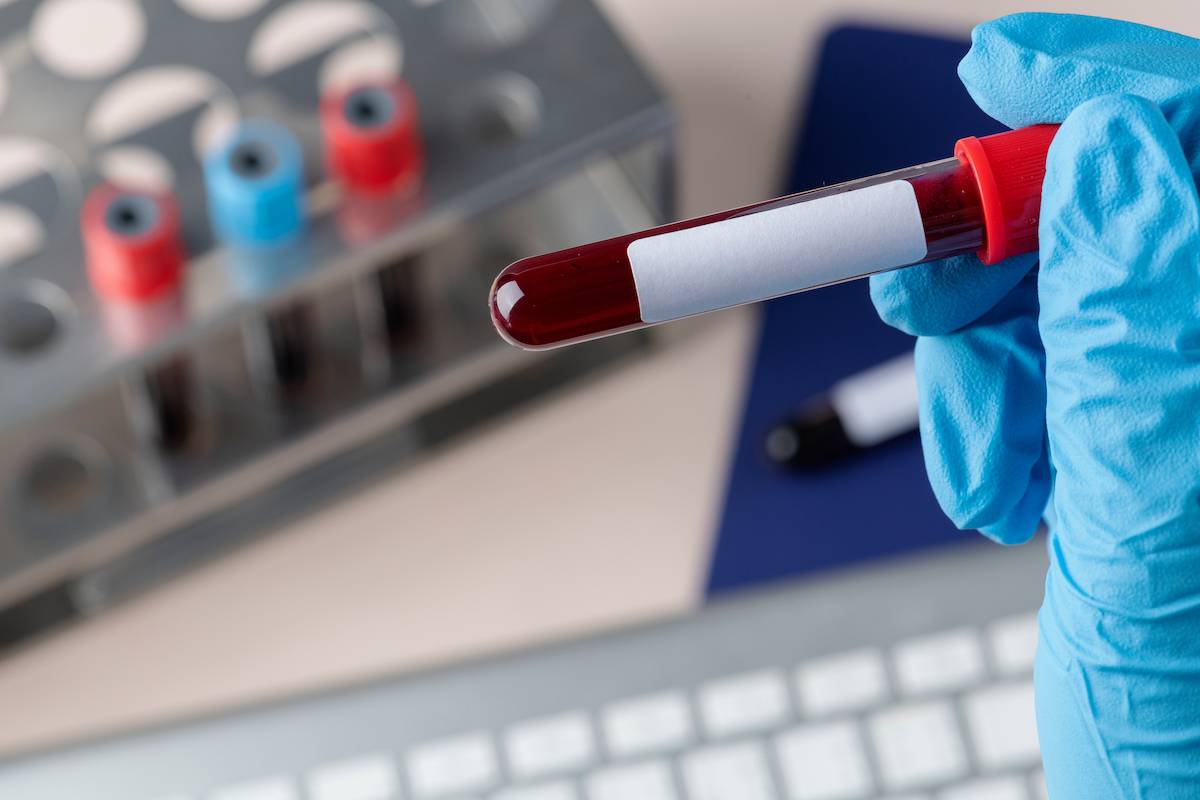 Un análisis genético de sangre para una detección precoz del párkinson