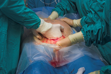 <p>Los investigadores recolectaron muestras de 18 niños, 7 nacidos vaginalmente y 11 por cesárea./ Fotolia</p>