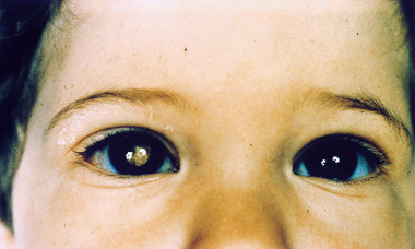 <p>Niño con retinoblastoma. / <a href="https://es.wikipedia.org/wiki/Retinoblastoma#/media/File:Retinoblastoma.jpg" target="_blank">Wikipedia</a></p>