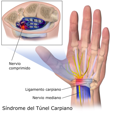 <p>Síndrome del túnel carpiano. / UVa</p>