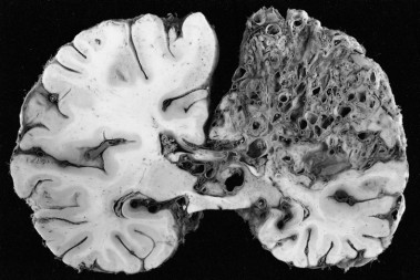 <p>Deformación arteriovenosa en el hemisferio izquierdo típica de la enfermedad. / <a href="http://en.wikipedia.org/wiki/Hereditary_hemorrhagic_telangiectasia#mediaviewer/File:AVM_grossly.jpg" target="_blank">Wikipedia</a></p>
