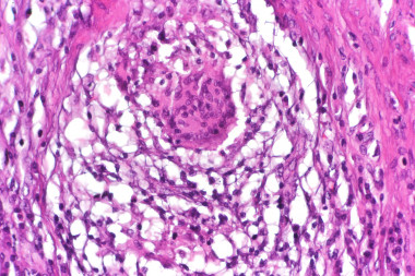 <p>Tejido afectado por la enfermedad de Crohn. / <a href="https://commons.wikimedia.org/wiki/File:Crohn%27s_colitis_-_Crohn%E2%80%99s_rosary,_very_high_mag.jpg" target="_blank">Wikimedia Commons</a> </p>