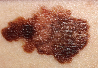 <p>Melanoma de unos 2,5 centímetros de diámetro. / <a href="https://es.wikipedia.org/wiki/Melanoma#/media/File:Melanoma.jpg" target="_blank">Wikimedia Commons</a></p>