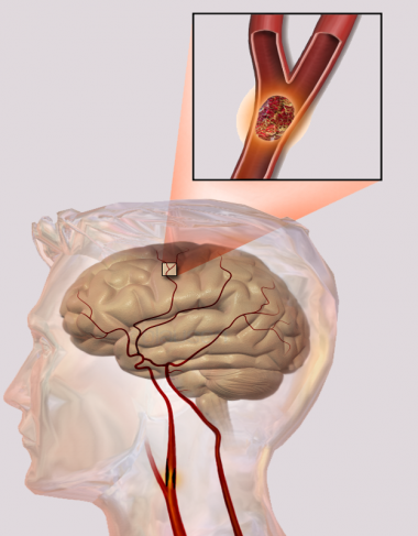 <p>Infografía de un ictus cerebral. / <a href="http://en.wikipedia.org/wiki/File:Blausen_0836_Stroke.png" target="_self">Wikipedia</a></p>