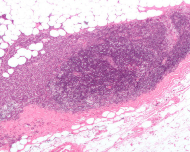 <p>Ganglio linfático invadido por carcinoma de mama ductal. / <a href="https://en.wikipedia.org/wiki/Breast_cancer#/media/File:Breast_carcinoma_in_a_lymph_node.jpg" target="_blank">Wikipedia</a></p>