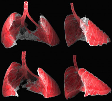<p>La figura muestra dos vistas, frontal y lateral, de la imagen obtenida por TAC de los pulmones de un ratón con fibrosis (zonas grises) antes y después de ser tratado con nanoterapia dirigida a las células senescentes. / G Garaulet i F Mulero, CNIO</p>