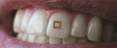 <p>Los sensores están formados por tres capas intercaladas: una capa central bioreactiva que absorbe el nutriente u otros químicos que se detectarán, y las capas externas que consisten en dos anillos de oro de forma cuadrada / Fio Omenetto, Universidad de Tufts</p>