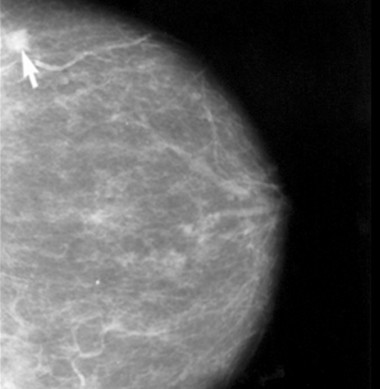 <p class=" text-left">Mamografía en la que se identifica un pequeño carcinoma. / Wikipedia</p>