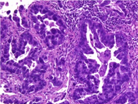 <p>Microfotografía de tumor de origen desconocido identificado como cáncer de pulmón usando el test EPICUP®. / IDIBELL</p>