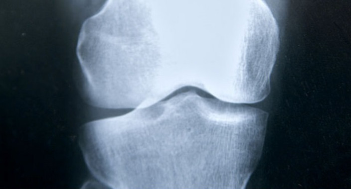 <p>La rareza de este problema ha hecho sospechar que había una predisposición genética que hacía que algunas personas fuesen propensas a presentar fractura atípica / <a href="https://www.flickr.com/photos/ansesgob/15355197979/in/photolist-3eMcSg-ravhLB-5dte5x-a2VYcG-poTpoK-s51Ggq-rFy58u-r2mCw4-rFGG1X-rY2zDs-s51QSy-rY2BuG-zGNrpS-zGNqsG-rA24t" target="_blank">ANSES</a></p>