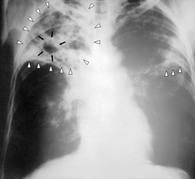 <p>Radiografía de tórax de una persona con tuberculosis. / <a href="http://commons.wikimedia.org/wiki/File:Tuberculosis-x-ray-1.jpg" target="_blank">Wikipedia </a></p>