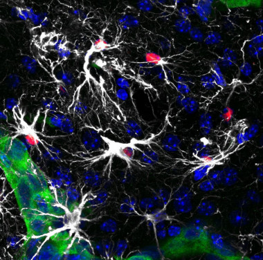<p>La imagen muestra células metastáticas en el cerebro (en verde) rodeadas por astrocitos reactivos (en blanco). Algunos de ellos tienen la vía de STAT3 activada (núcleo en rojo). Los astrocitos reactivos con STAT3 activo ayudan a las células tumorales a crecer y desarrollarse en el cerebro modificando la inmunidad local. / CNIO</p>