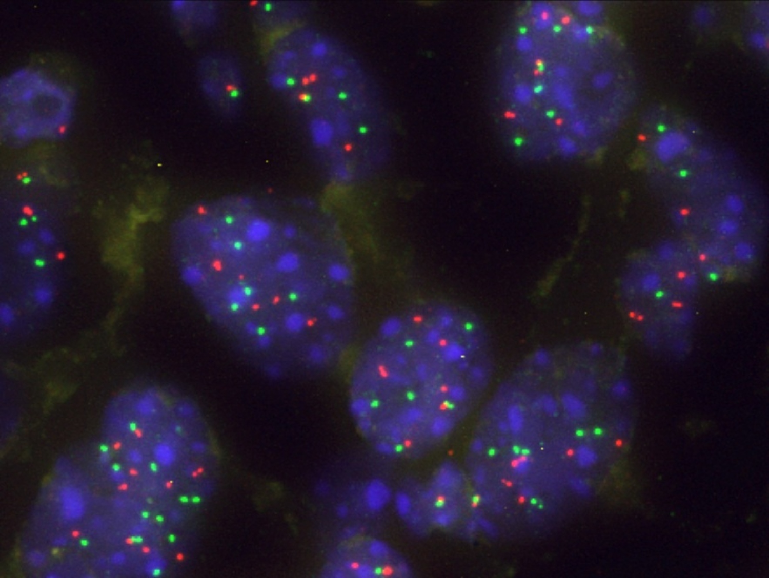 Una proteína actúa como barrera natural frente a la progresión del cáncer de pulmón