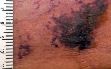 <p>La calcifilaxis tiene su origen en la calcificación cardiovascular masiva de pequeños vasos sanguíneos periféricos. / <a href="http://upload.wikimedia.org/wikipedia/commons/5/5c/Calciphylaxis.png" target="_blank">Wikipedia</a></p>
