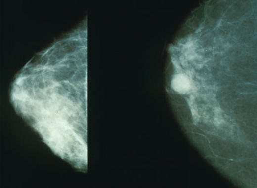 <p>Imagen de una mama sana (izquierda), contrapuesta a otra afectada por un cáncer de mama (derecha). Imagen: Wikipedia</p>