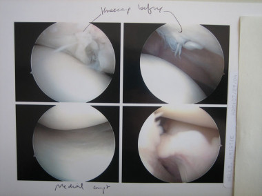 
<!-- START: including template: extension/sinc/design/ezwebin/templates/content/datatype/view/ezxmltags/paragraph.tpl (design:content/datatype/view/ezxmltags/paragraph.tpl) -->
<p>La osteoartritis se caracteriza por la alteración del cartílago y del hueso subcondral. En la imagen, un 
<!-- START: including template: extension/sinc/design/standard/templates/content/datatype/view/ezxmltags/link.tpl (design:content/datatype/view/ezxmltags/link.tpl) -->
<a href="http://plataformasinc.es/index.php/esl/imagenes/inicio/(imagen)/55345" target="_self">cartílago dañado de la rodilla</a>
<!-- STOP: including template: extension/sinc/design/standard/templates/content/datatype/view/ezxmltags/link.tpl (design:content/datatype/view/ezxmltags/link.tpl) -->
. Foto: Kristie Wells.</p>
<!-- STOP: including template: extension/sinc/design/ezwebin/templates/content/datatype/view/ezxmltags/paragraph.tpl (design:content/datatype/view/ezxmltags/paragraph.tpl) -->
