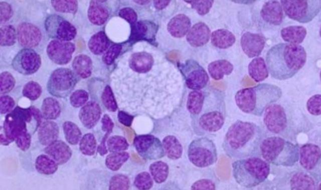 <p>El mieloma múltiple es un tipo de cáncer de la médula ósea en el que existe una proliferación anormal de células plasmáticas (en la imagen). / Lorenzo Melchor </p>
