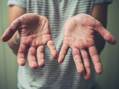 <p>After several days of measles infection, the characteristic skin rash appears on the face, neck, hands and feet. / Fotolia</p>
